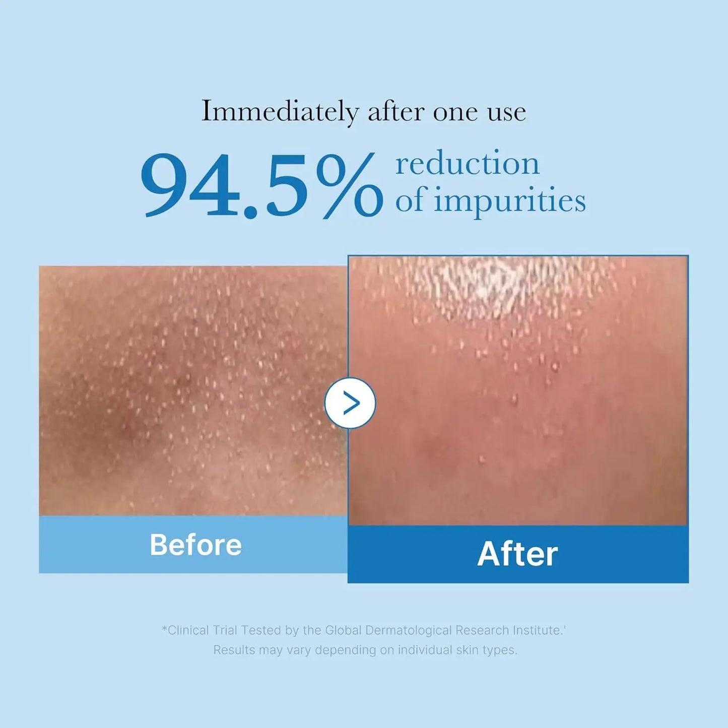 Cleansing oil bottle for blackhead removal and daily makeup removal, suitable for all skin types.